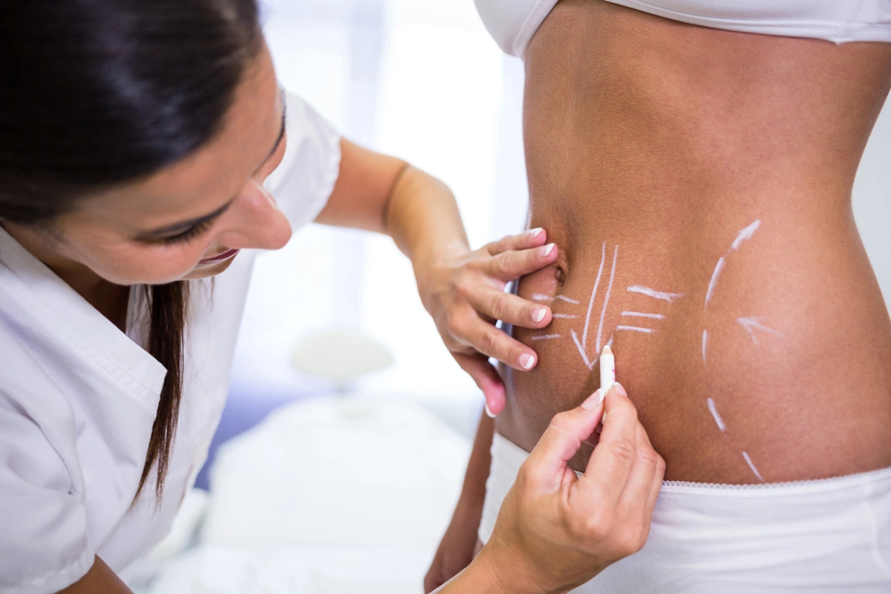 surgeon-drawing-lines-womans-abdomen-liposuction-cellulite-removal